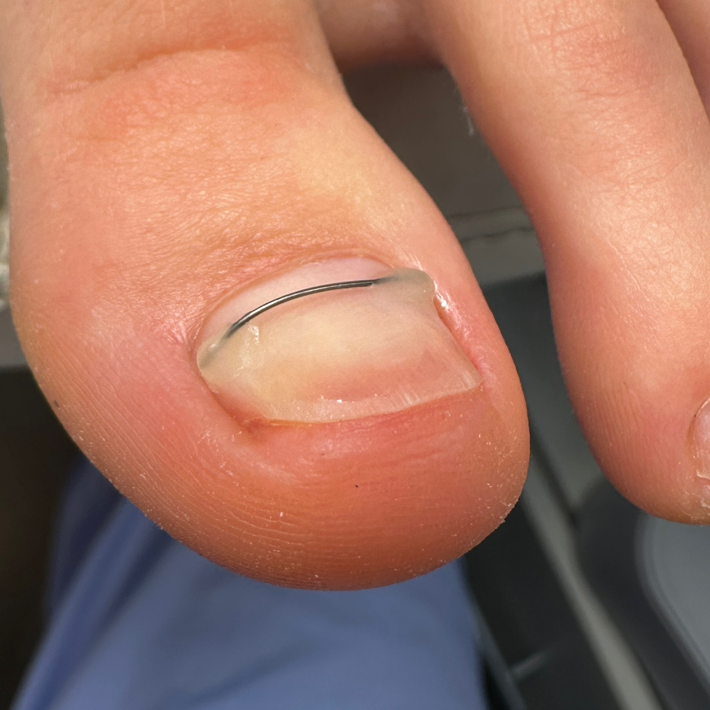 Установка титановой нити