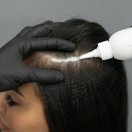 лечение перхоти