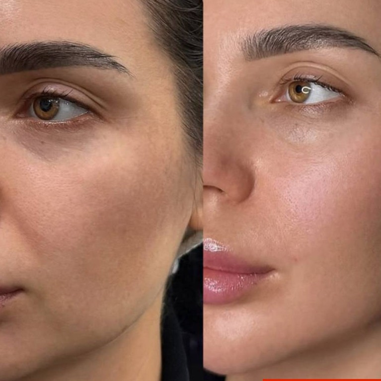 Биоревитализация глаз