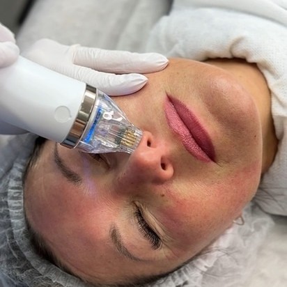 Микроигольчатый рф лифтинг