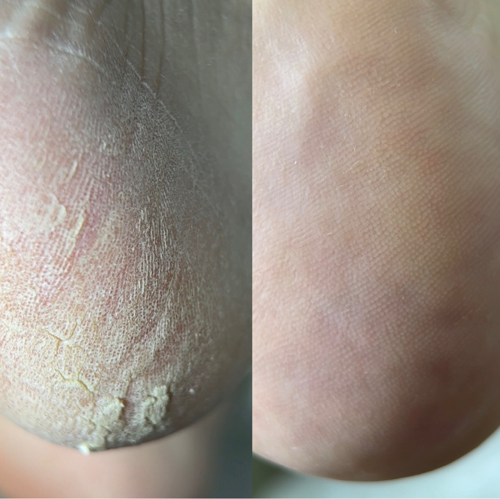 Кислотный педикюр  стоп ( без пальчиков ,без покрытия)