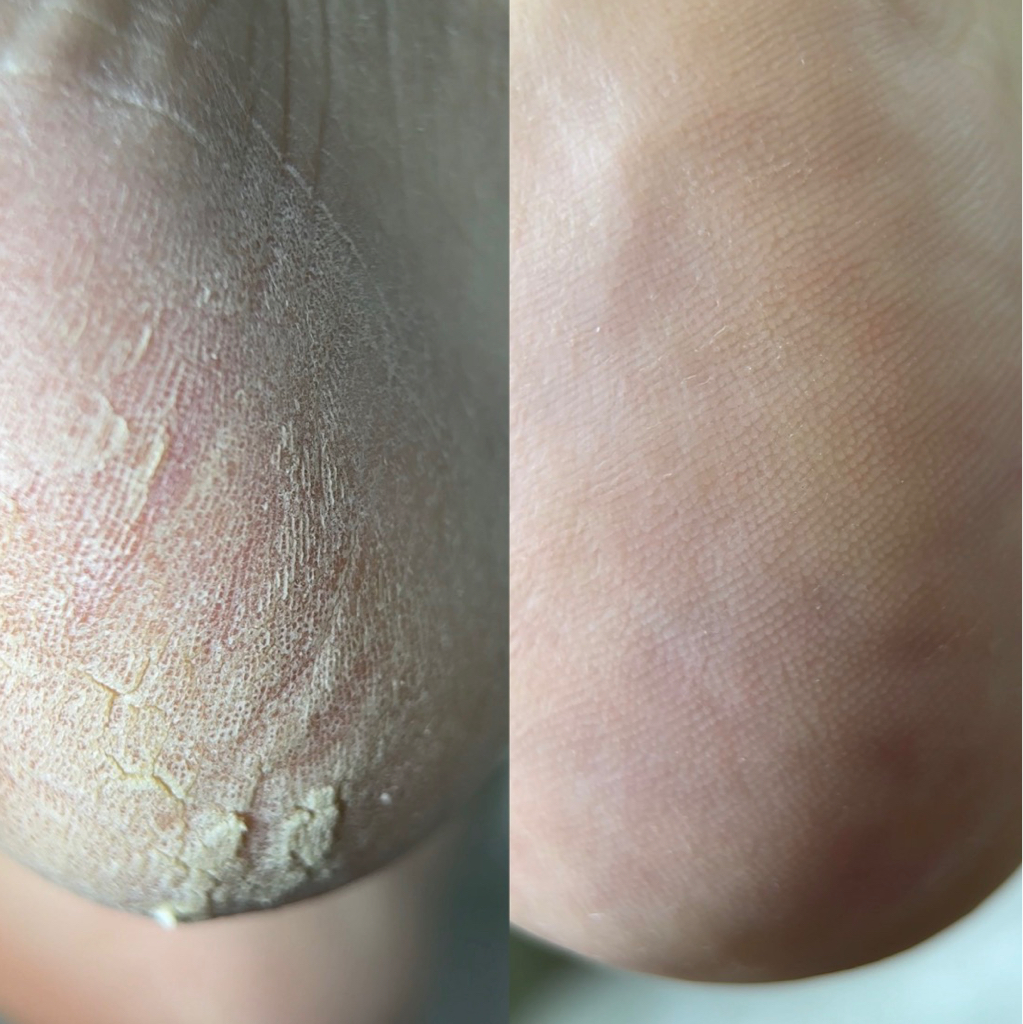 Кислотный педикюр стоп, пальчиков (без покрытия)