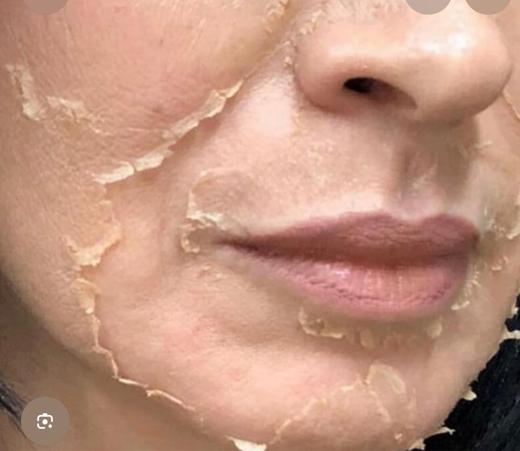 Пилинг Джесснера