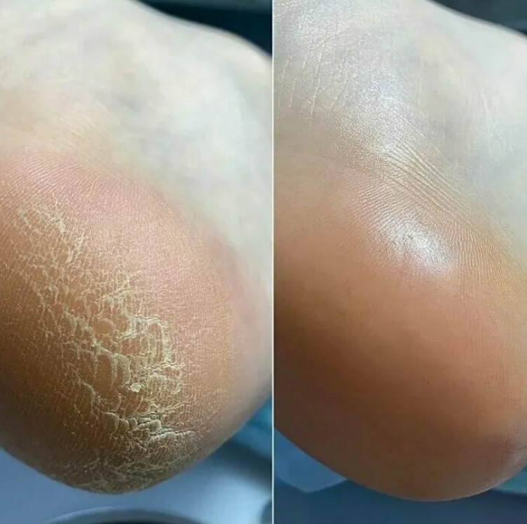 ПЕДИКЮР СЛОЖНЫХ стоп