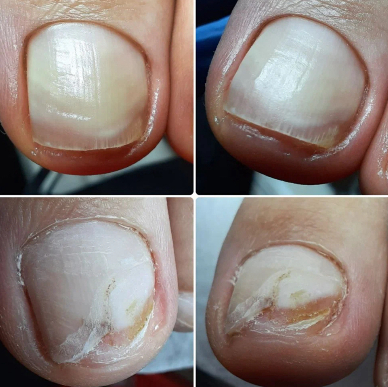 ЗАЧИСТКА НОГТЕВОЙ пластины