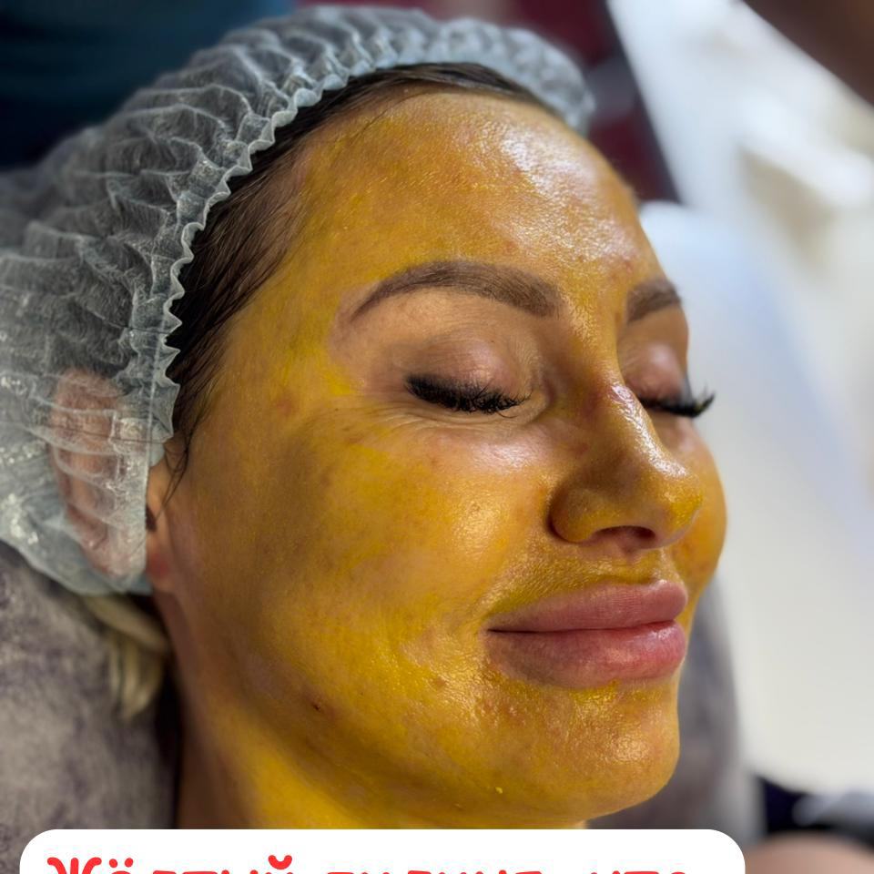 Ретиноловый или желтый пилинг