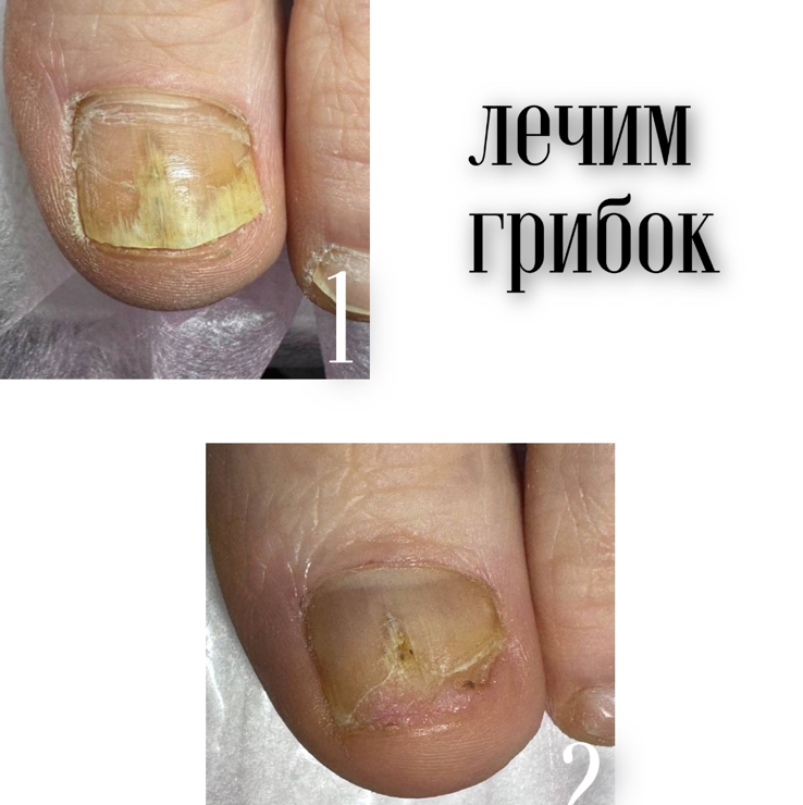 Первичный прием с обработкой грибковых ногтей