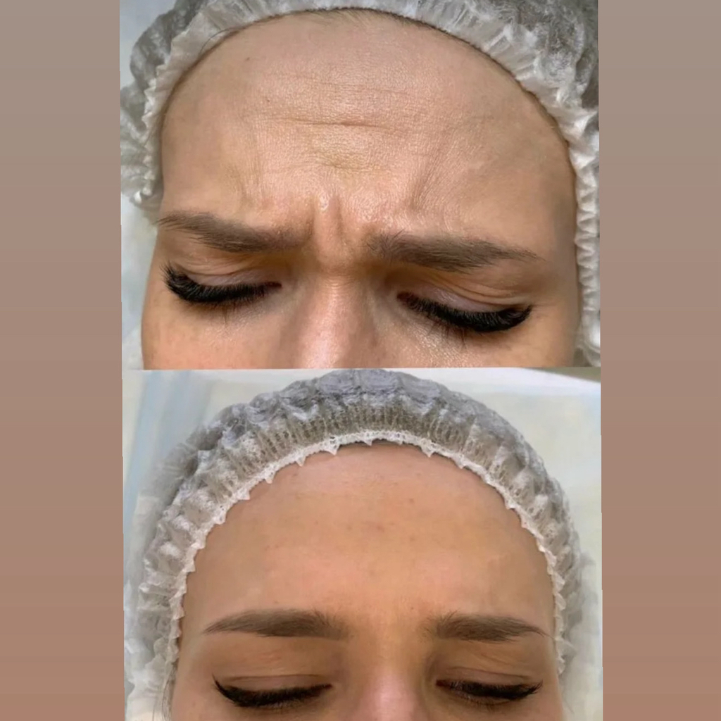 Ботокс / межбровье