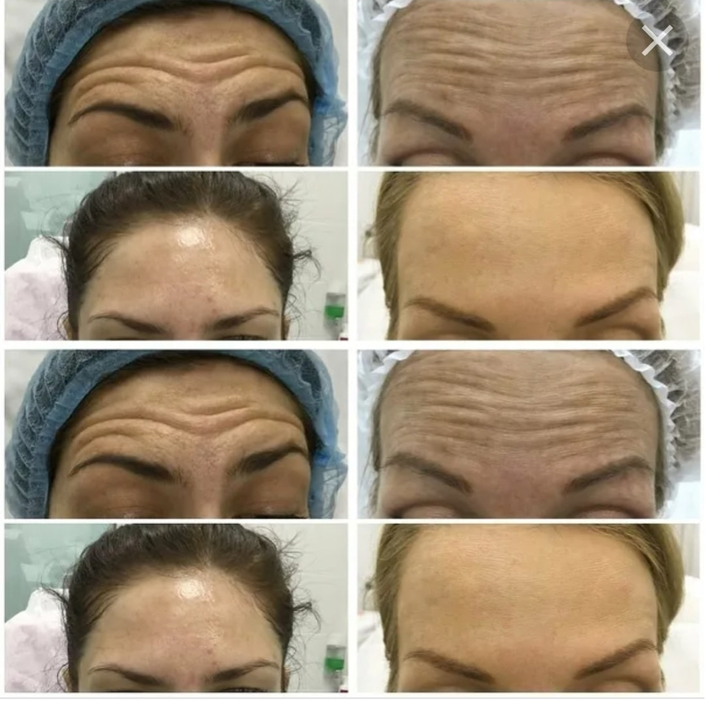 Ботокс за 1 ед.