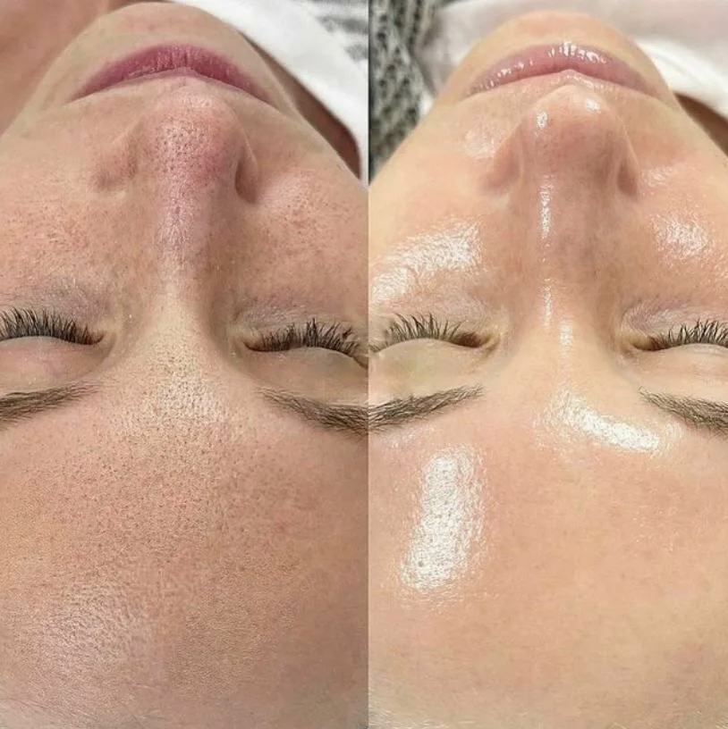 Инновационный пилинг BioRePeel