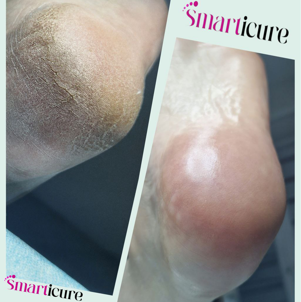 SMARTICURE педикюр