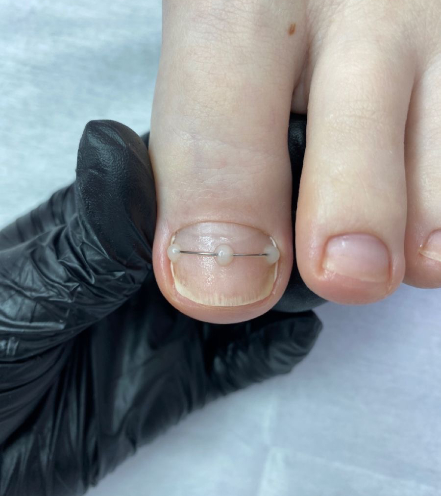 Титановая нить