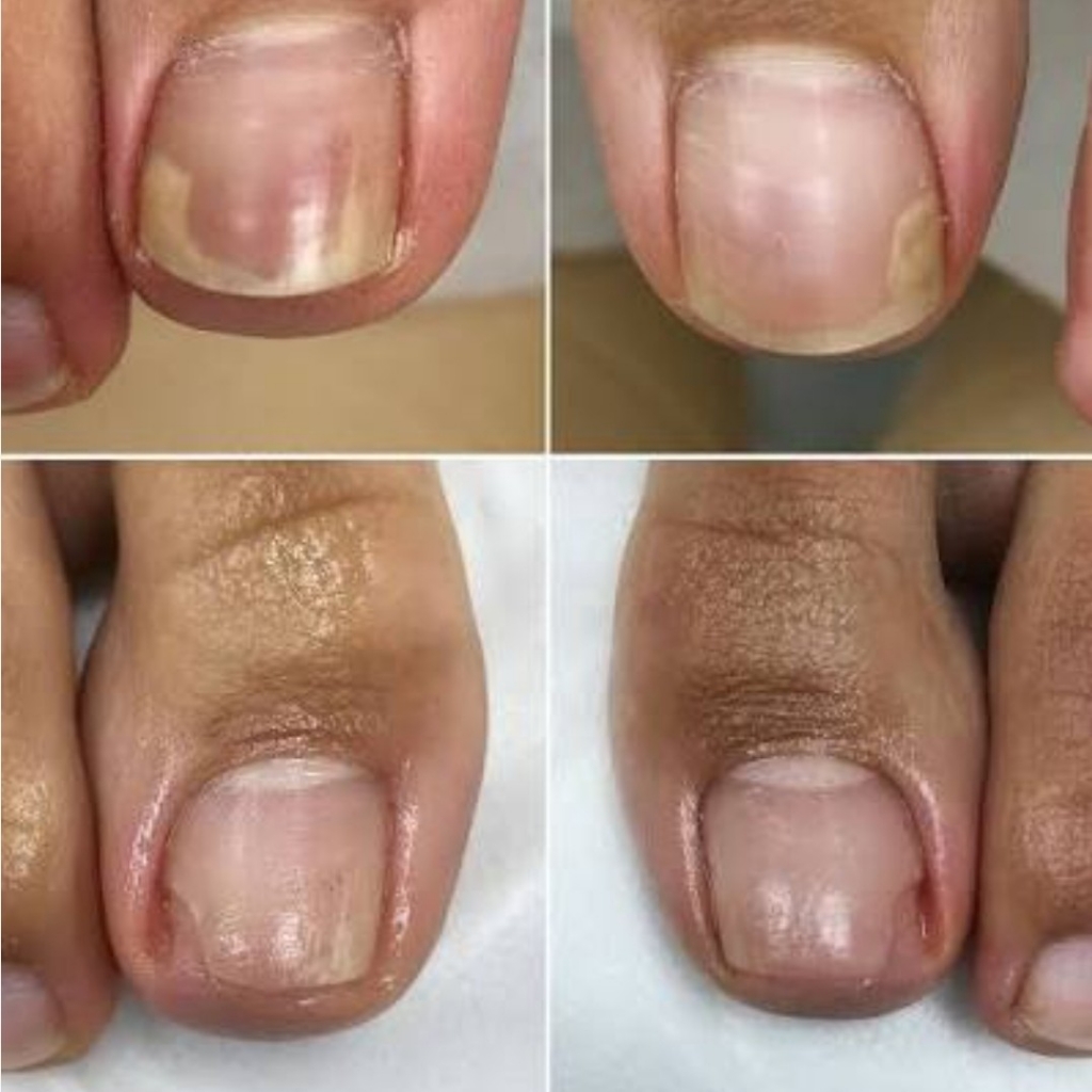 Обработка/очистка от онихолизиса(1 ноготь)