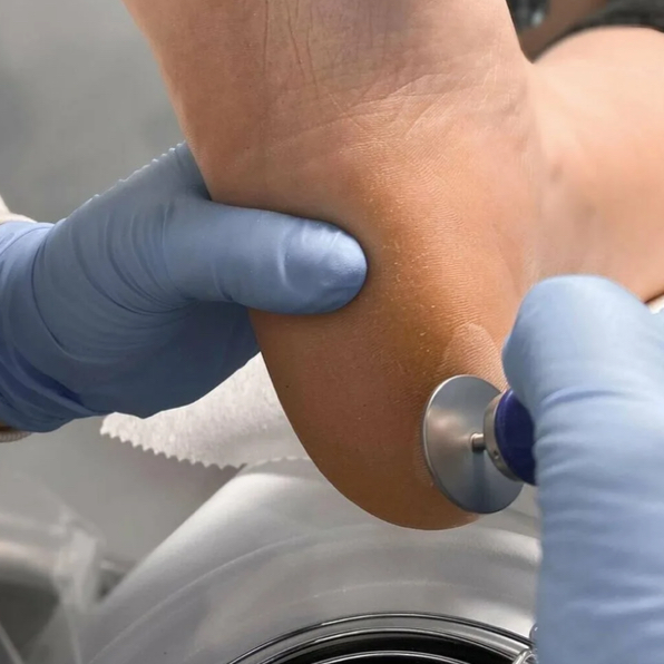 Обработка стопы смарт-диском