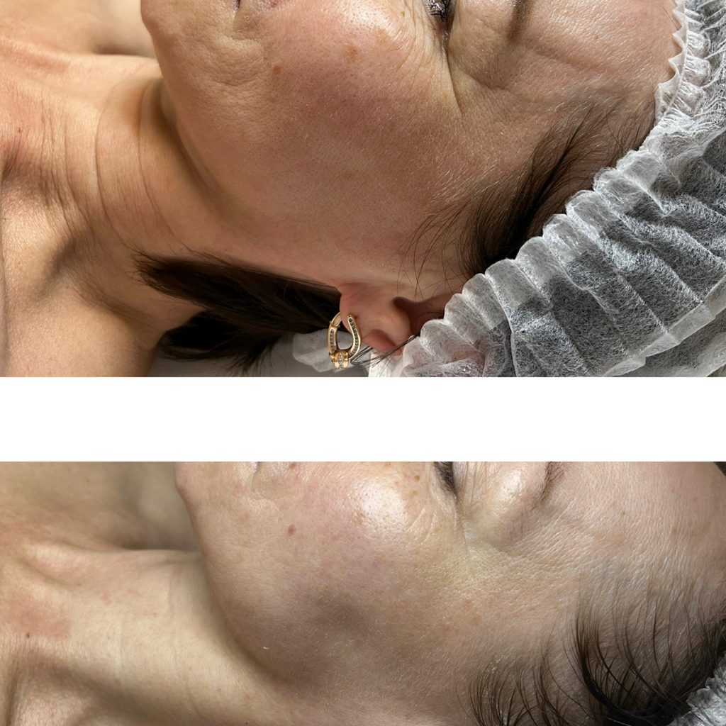 БЕЗЪИНЪЕКЦИОННАЯ ПРОЦЕДУРА КОРРЕКЦИИ МОРЩИН «Жидкий лазер» на премиальной уходовой косметике