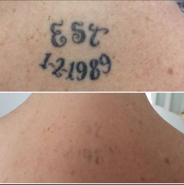 Лазерное удаление тату