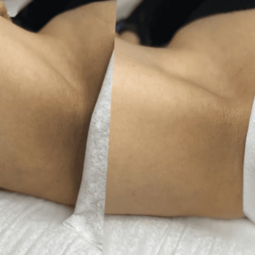 Интимное отбеливание