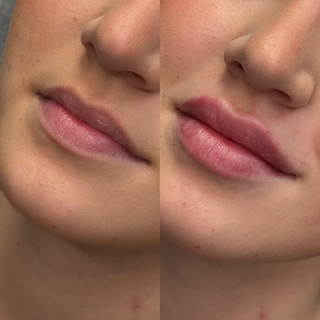 Контурная пластика губ