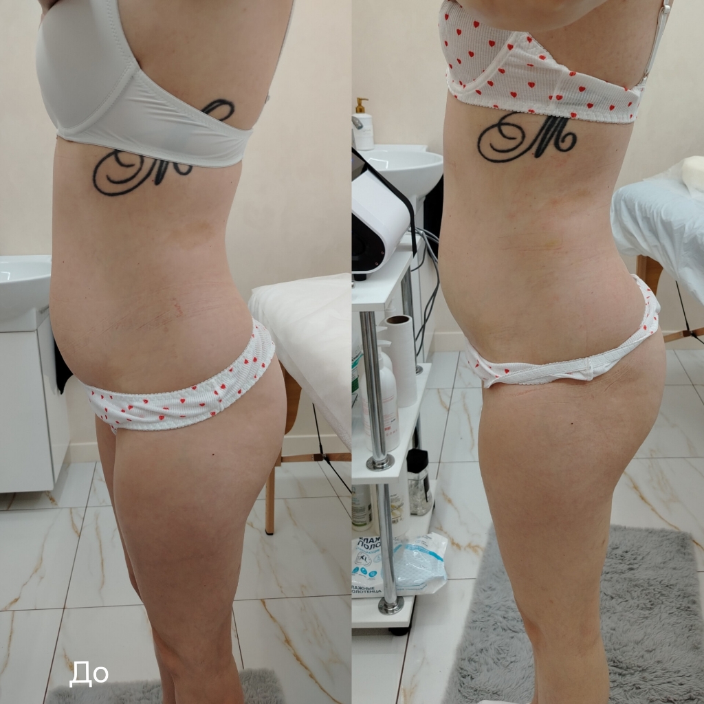 Rf-лиф живот+ бока