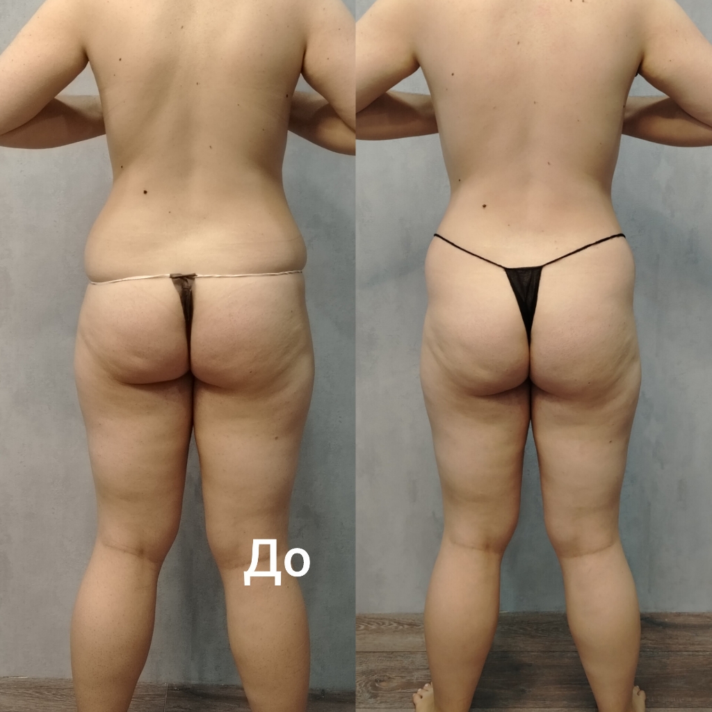 Кавитация бедра