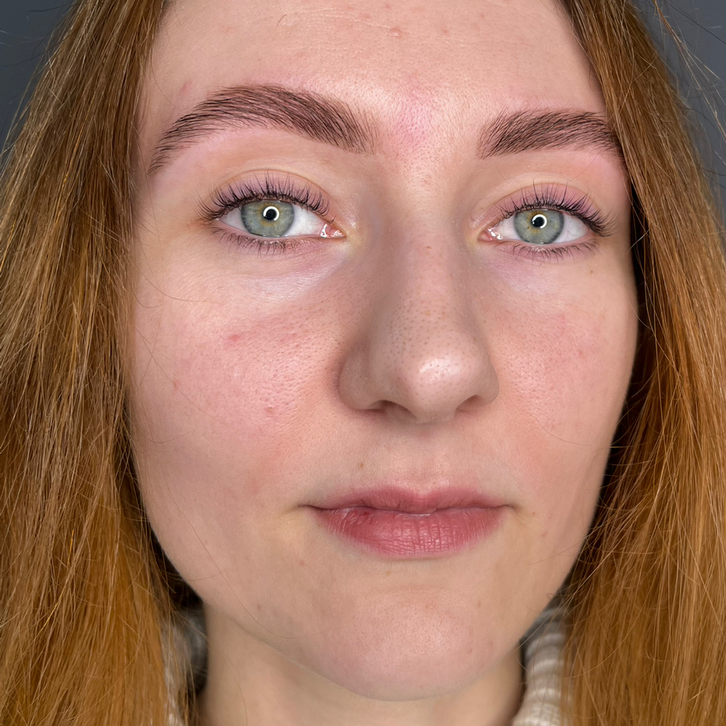 Эпиляция верхней губы