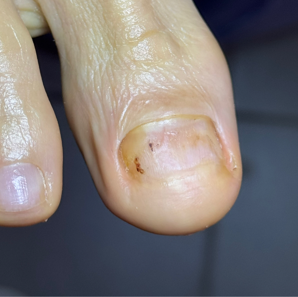 Зачистка онихолизиса (1 палец)