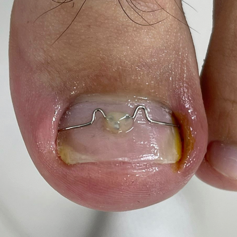 Установка корректирующей системы 3 ТО