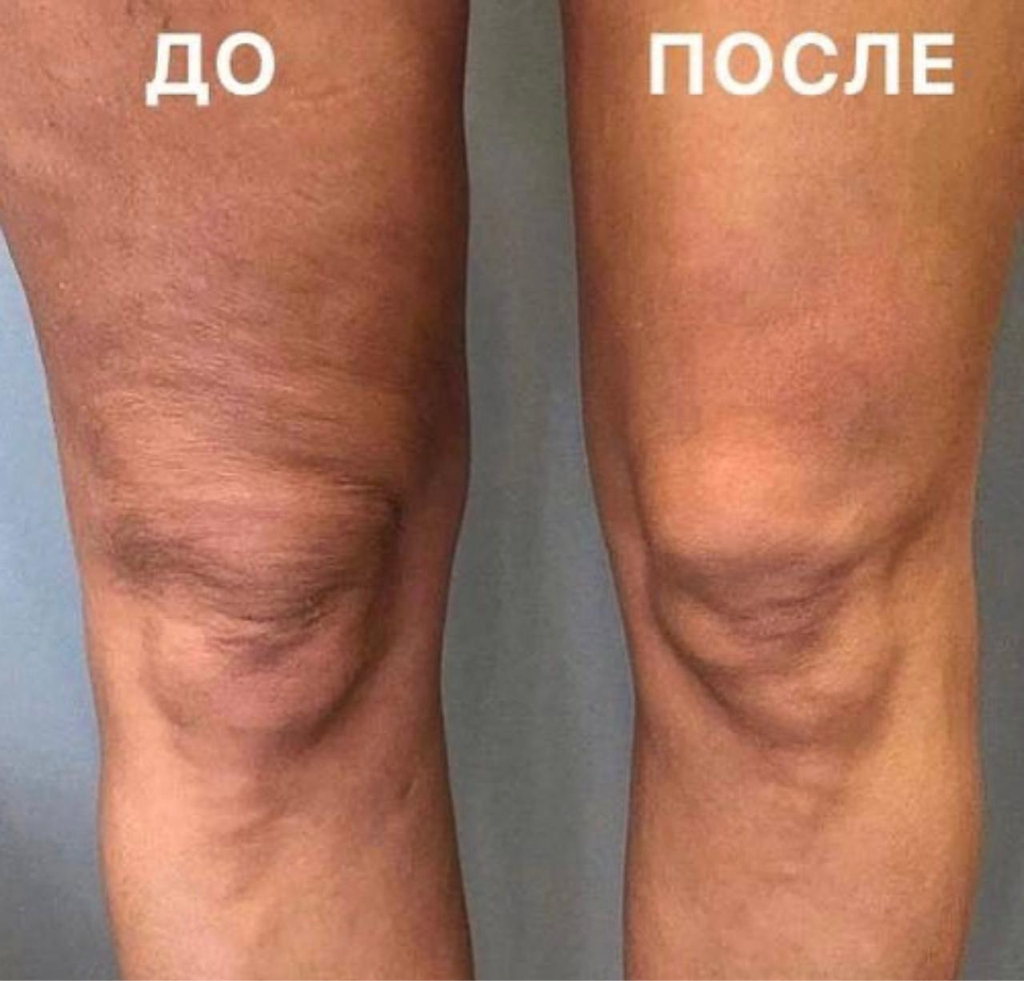 Smas : зона колени