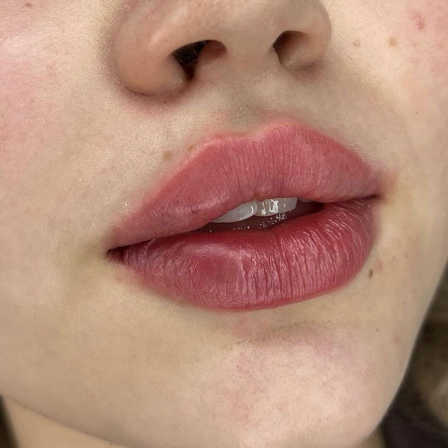 Увеличение губ