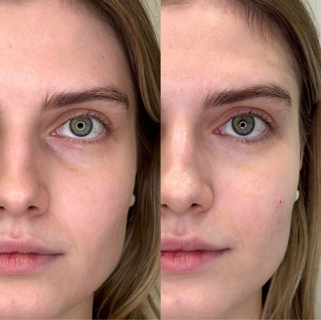 Контурная пластика заполнение носослезной борозды Teosyal PureSense Redensity 2  1мл