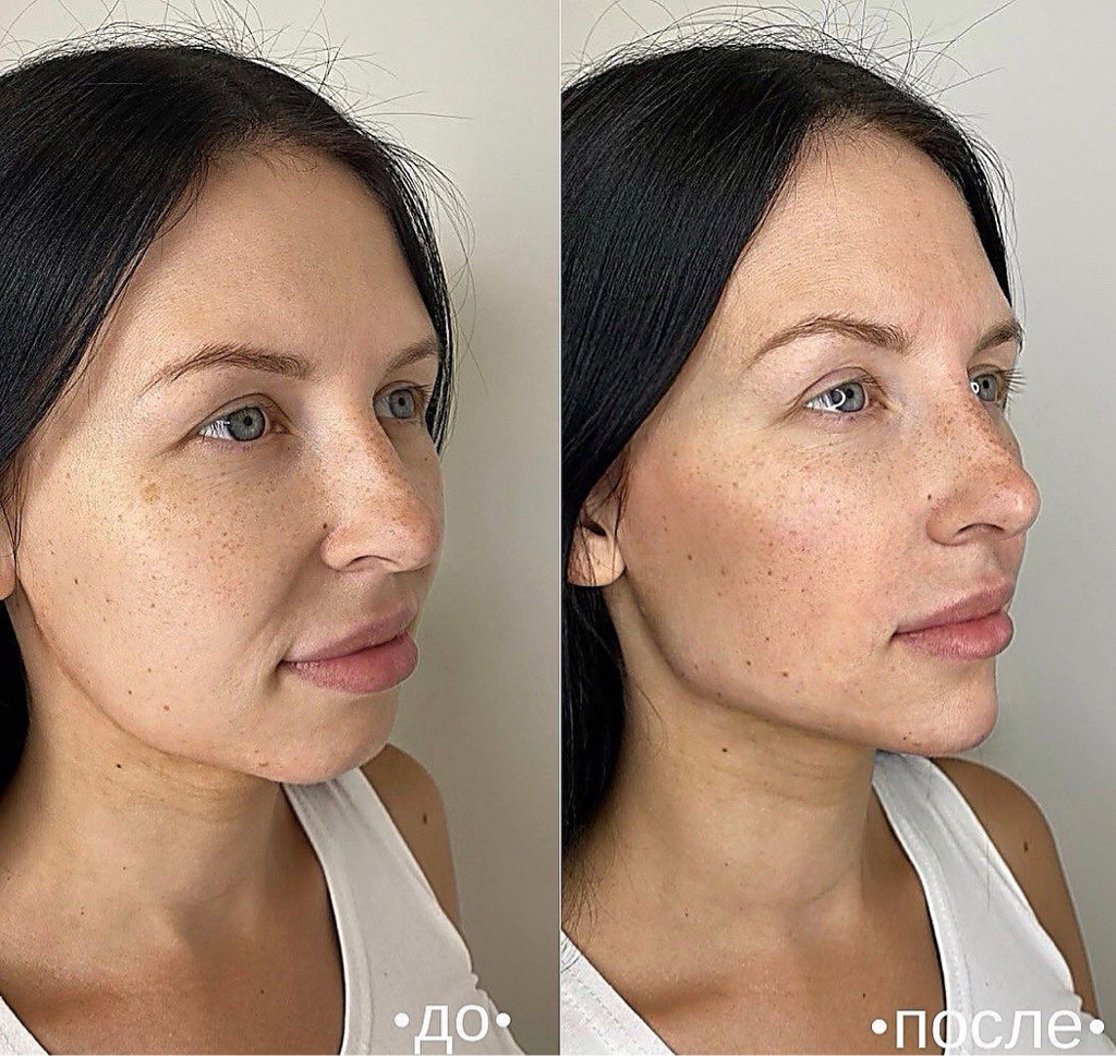 Полный Full Face лица+ полный Fullface Botox