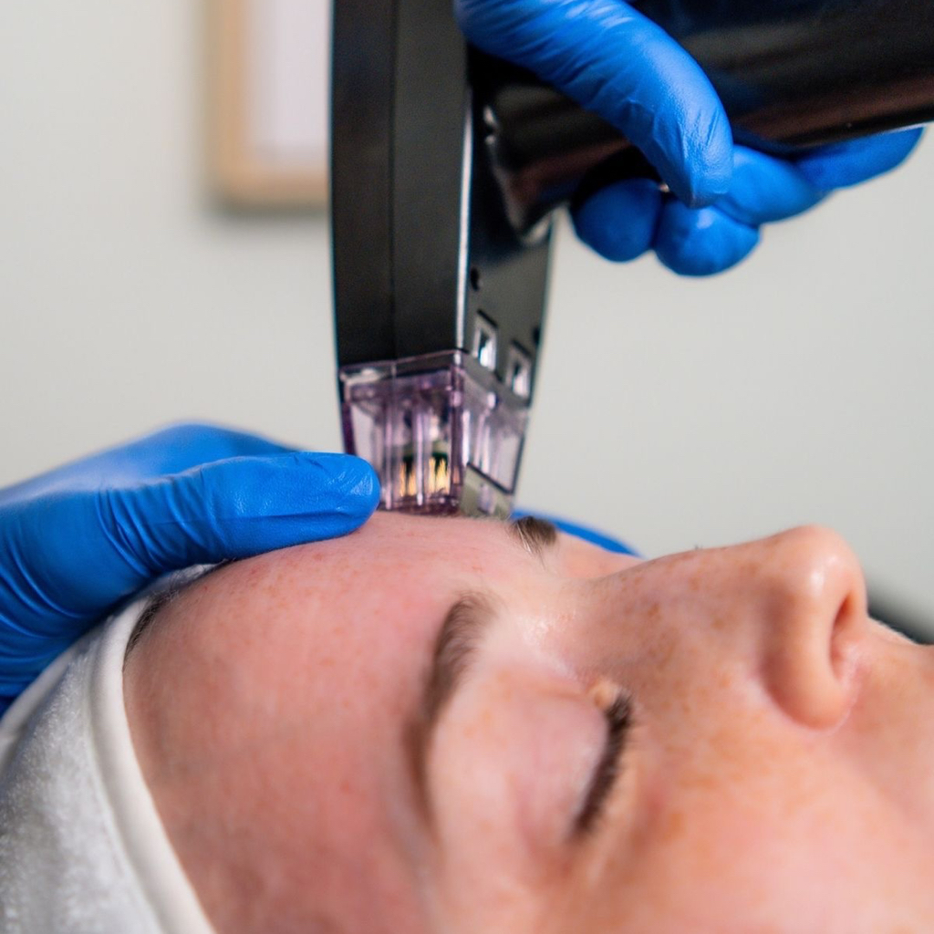 Morpheus 8 RF лифтинг лицо