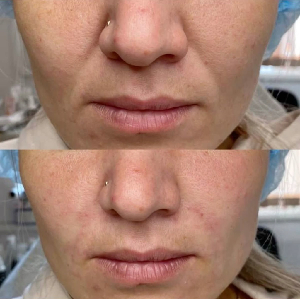 Контурная пластика носогубные складки Stylage L 17.000