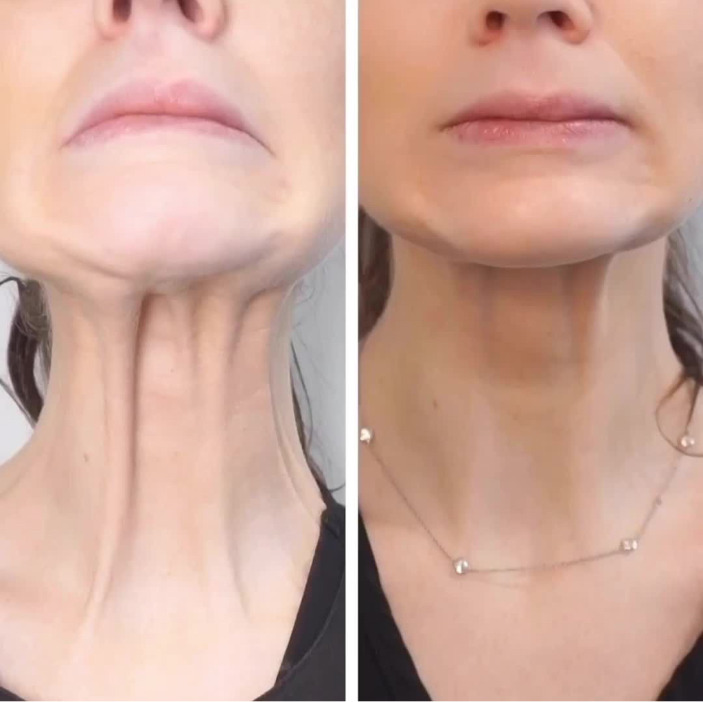 Botox расслабление мышц шеи 100 ед