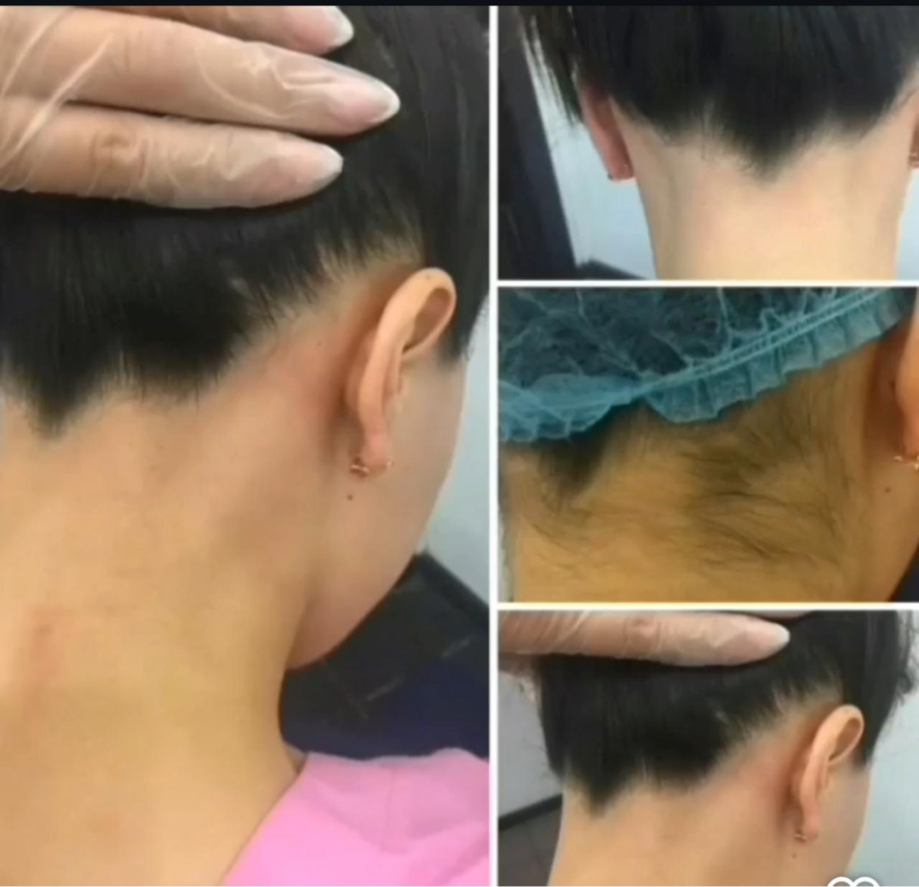 Эпиляция ниткой верхняя губа