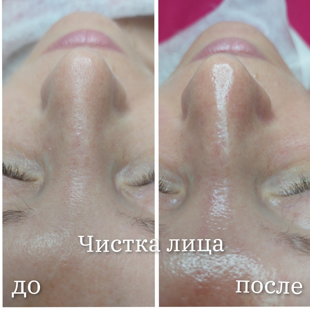 Чистка лица ультразвуковая