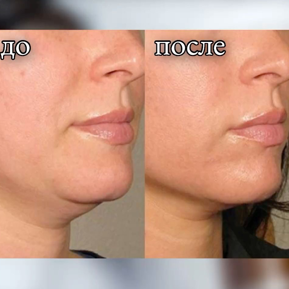 Липолитик F&b 8мл