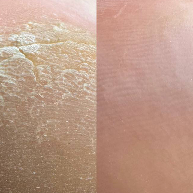 Обработка проблемных стоп