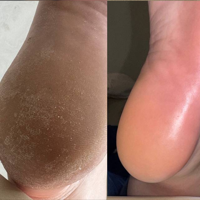 Обработка стопы