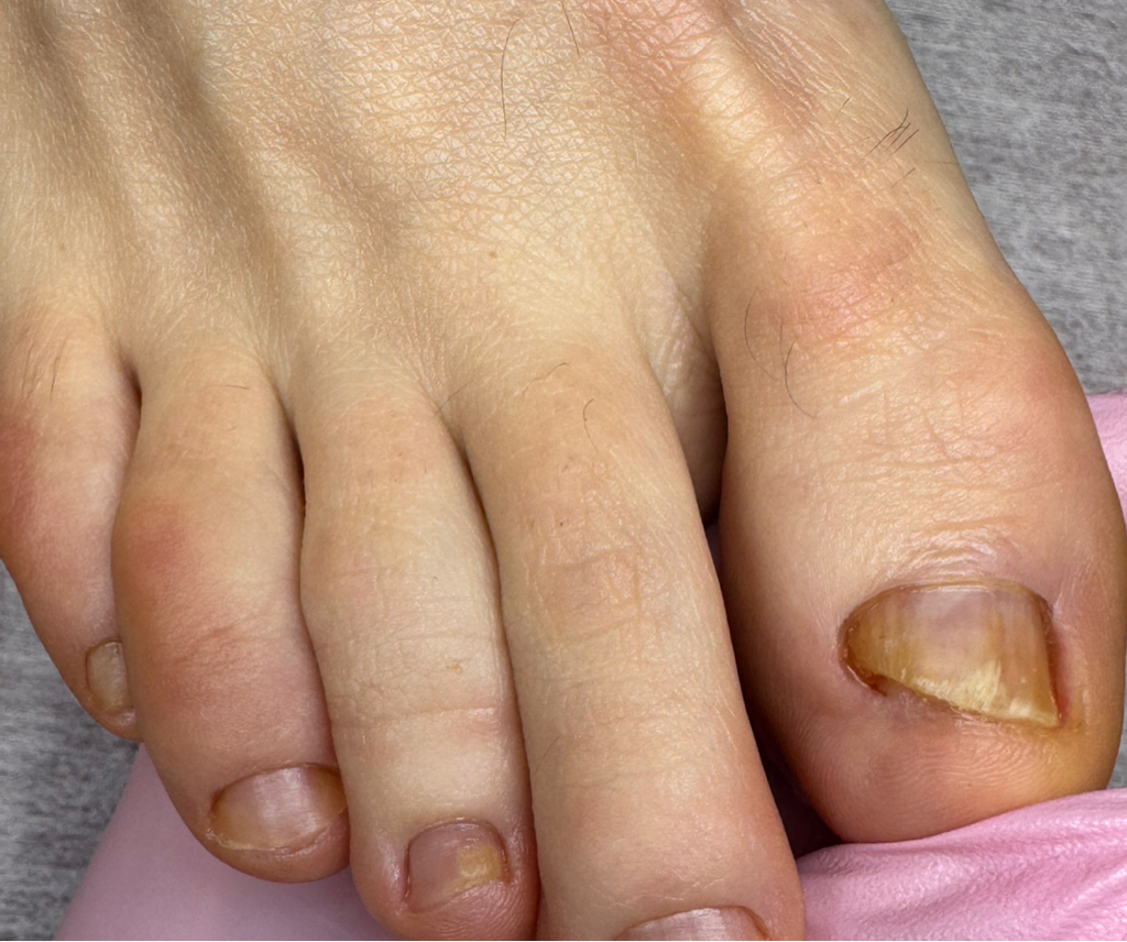 Повторный прием комплексная подологическая обработка (обработка стоп и ногтей при наличии 1 и более проблемных зон)