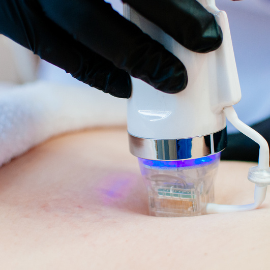 Микроигольчатый РФ-лифтинг (лицо/тело)