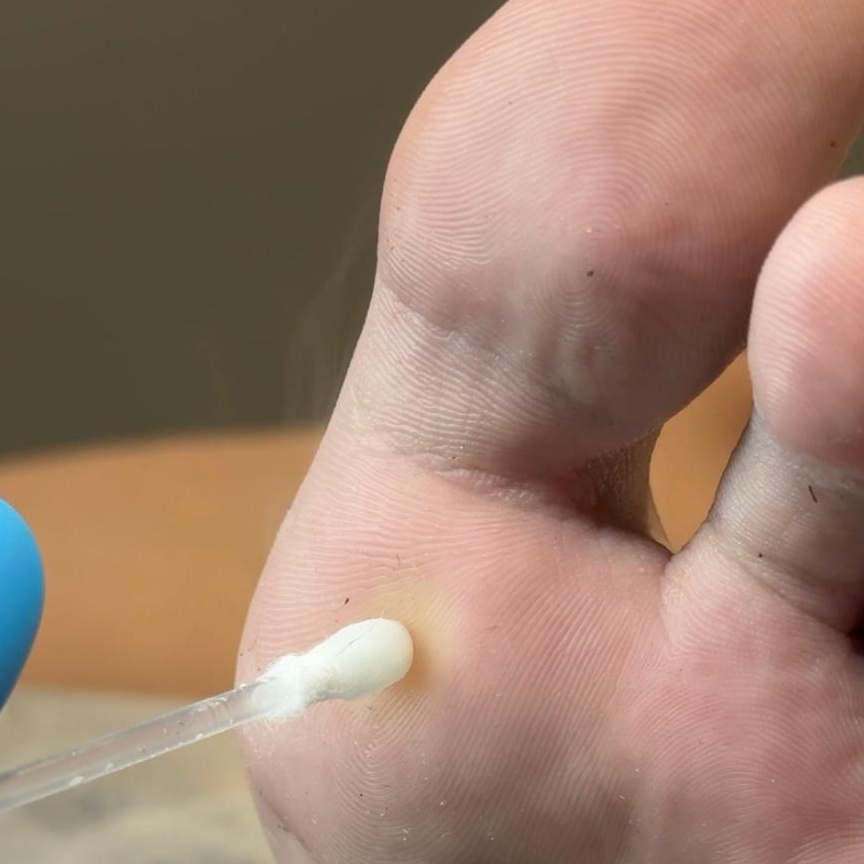 Обработка впч