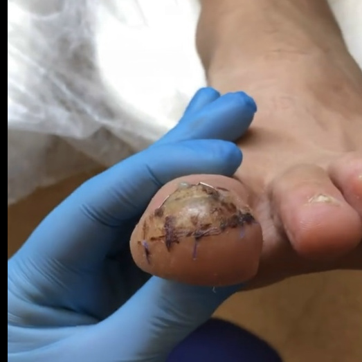 Снятие швов