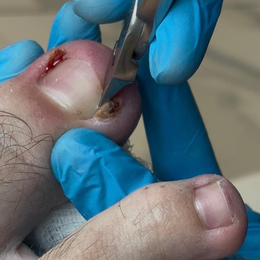 Обработка вросшего ногтя