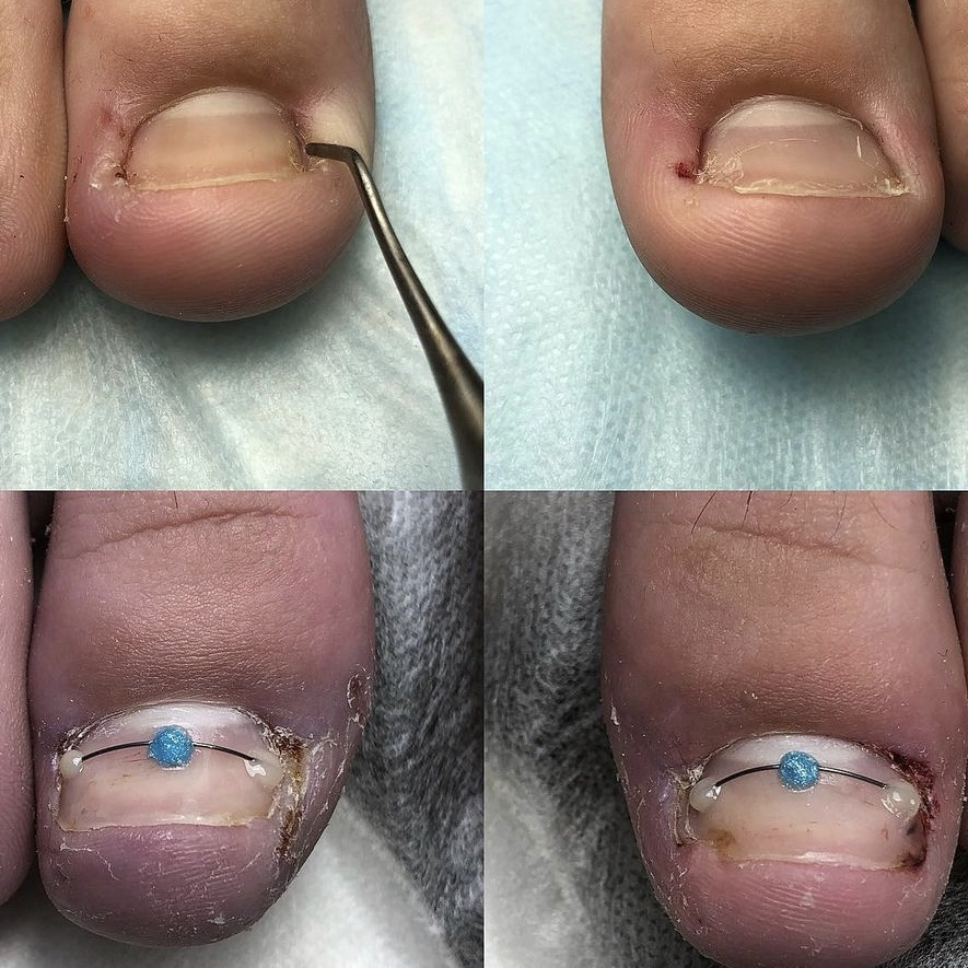 Титановая нить