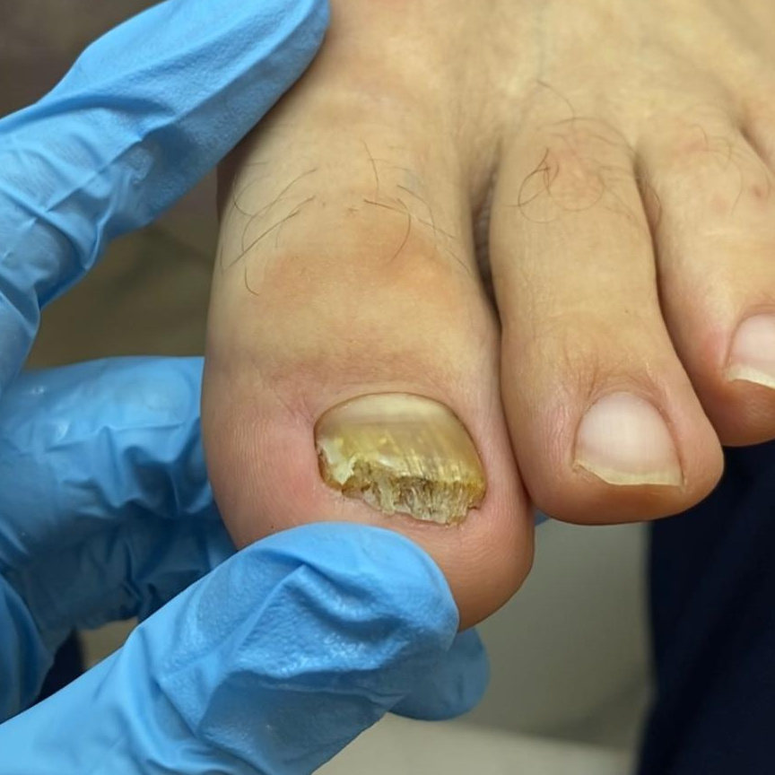 Чистка микозных ногтей и онихолизиса
