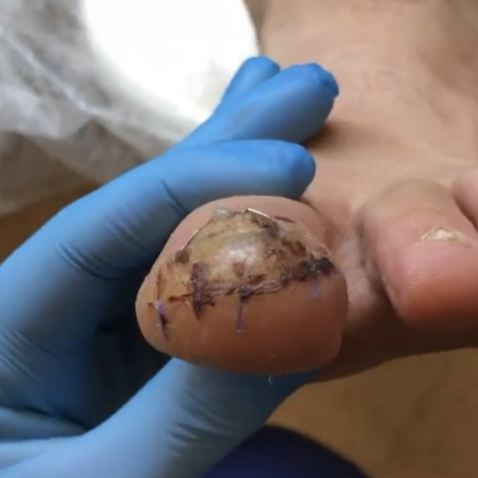 Снятие швов х2