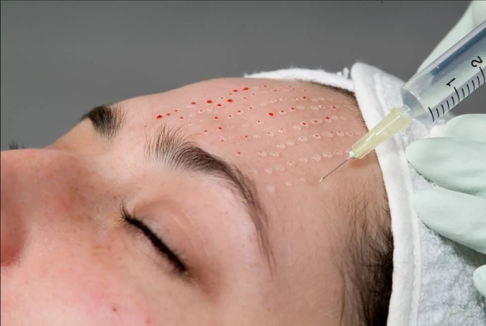 Мезотерапия (лицо)