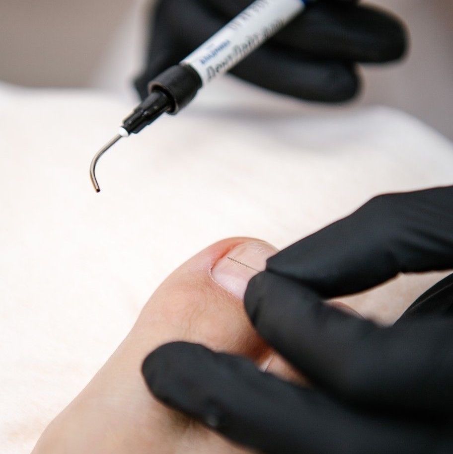 Установка скобы 3то, титановая нить