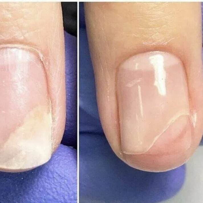 Резекция ногтевого ложа при анихолизисе 1 пальчик